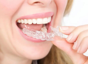 Niềng khay trong suốt Invisalign
