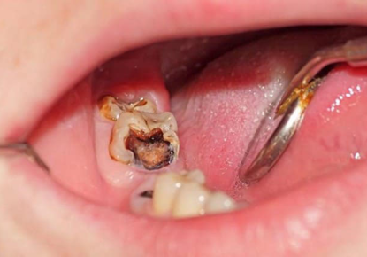 Dấu hiệu nhận biết viêm tủy răng sớm & cách điều trị dứt điểm